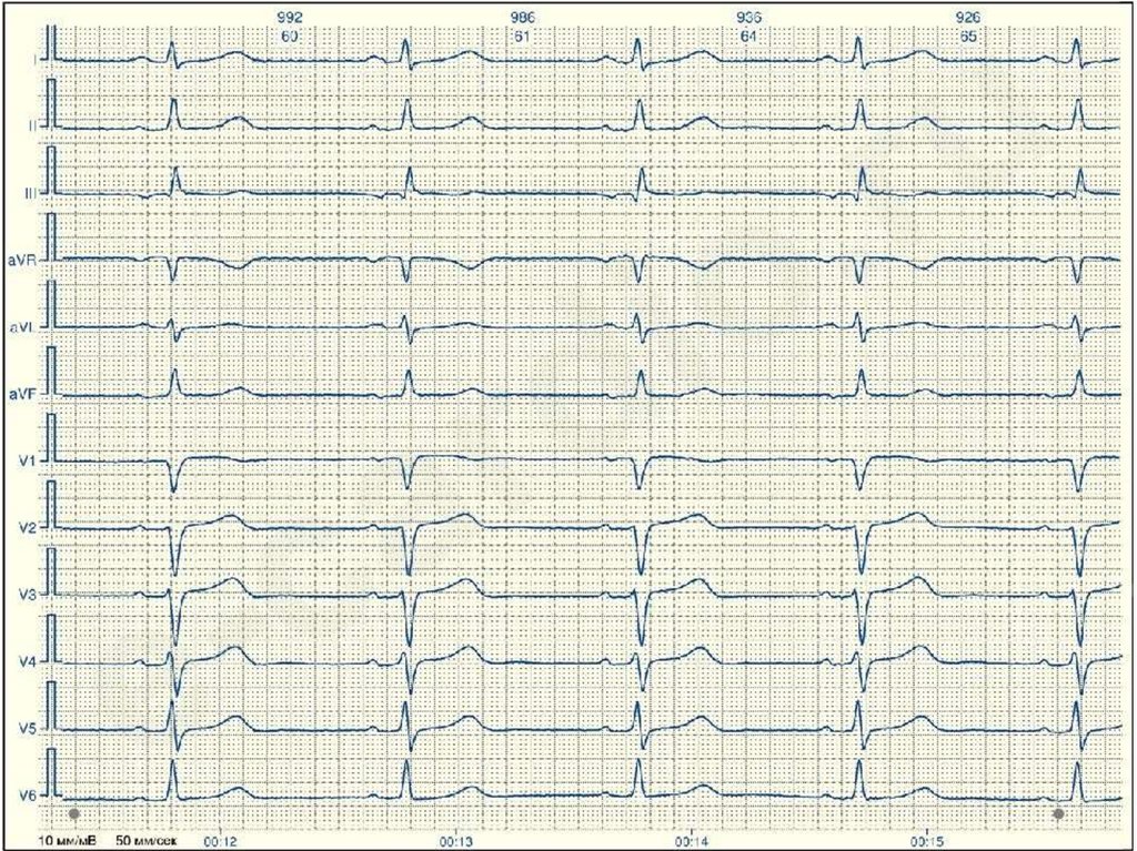 Экг презентация терапия