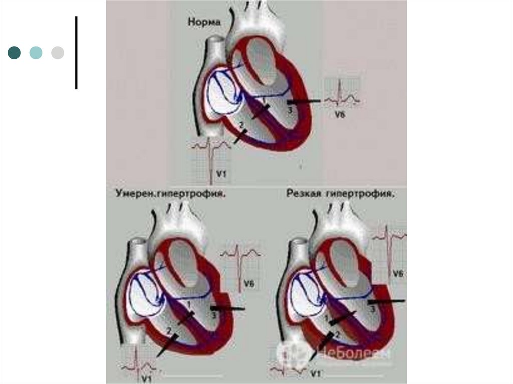 Желудочка сердца расширена. 2. Гипертрофия правого желудочка:. Гипертрофия желудочков сердца — сердце. Правожелудочковая гипертрофия. Причины гипертрофии миокарда левого и правого желудочка.