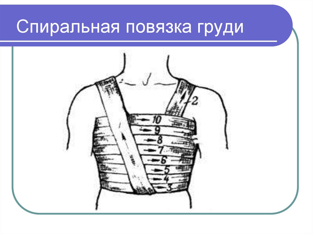 Наложение окклюзионной повязки при пневмотораксе. Спиральная повязка. Спиральная повязка на грудную. Спиральная повязка на грудь. Спиральная повязка на грудину.
