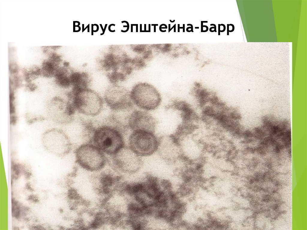 Инфекционный мононуклеоз вирус эпштейна. Вирус Эпштейна-Барр поражение зева. Вирус Эпштейна-Барр фото. Жемчужины Эпштейна-Барр у новорожденного.