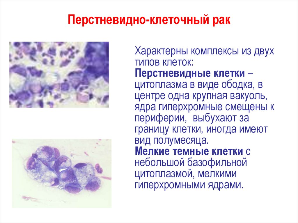Клетки с гиперхромными ядрами. Перстневидно-клеточная карцинома желудка гистология. Перстневидно клеточная карцинома. Перстневидноклеточный аденокарциномы.