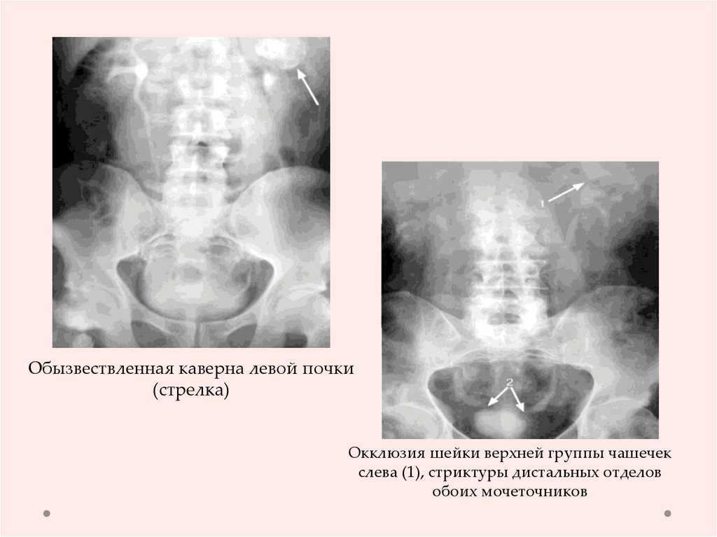 Туберкулез мочеполовых органов презентация