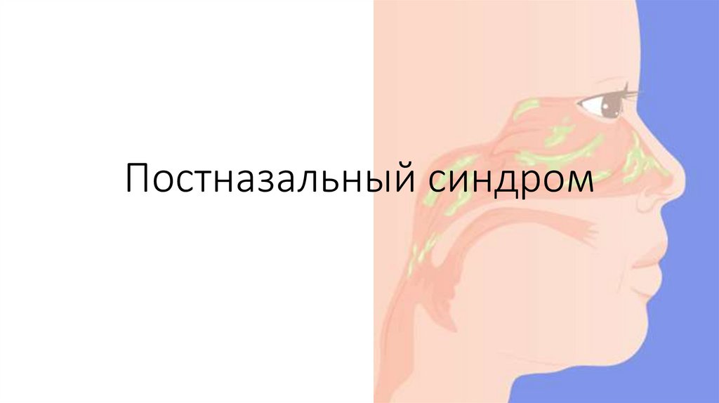 Постназальный синдром - презентация онлайн