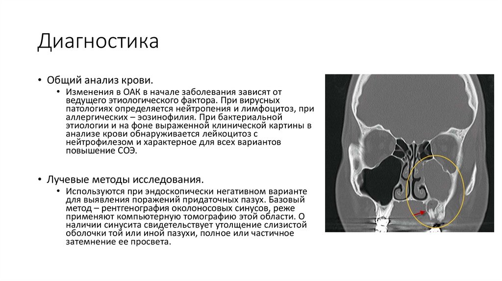 Постназальный синдром - презентация онлайн