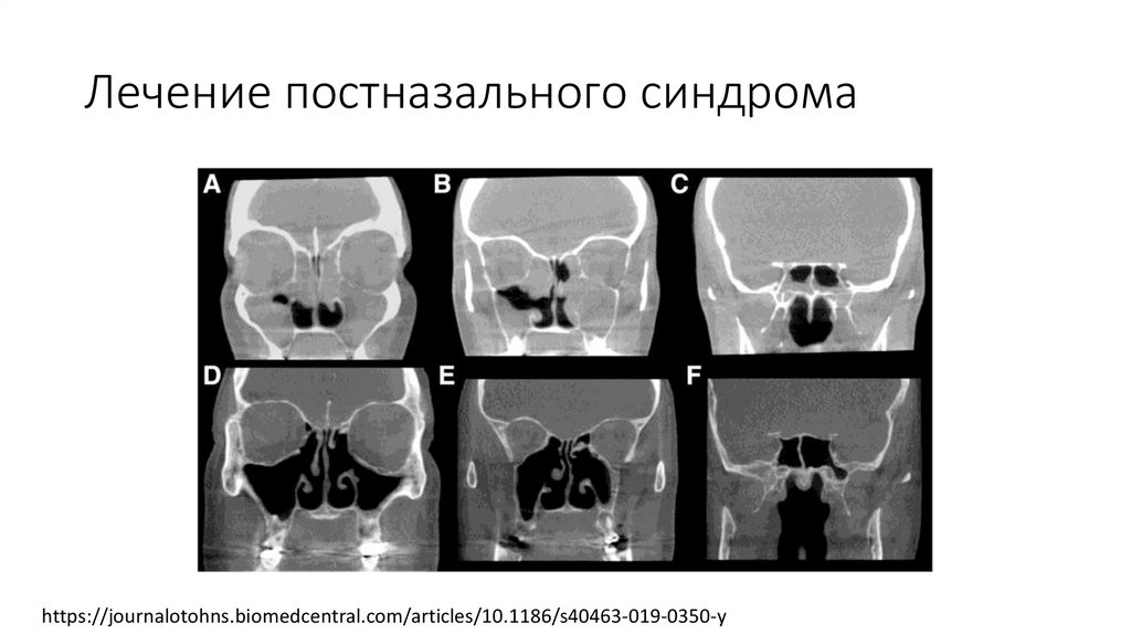 Постназальный синдром - презентация онлайн