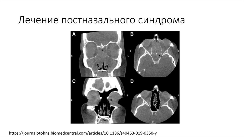 Постназальный синдром - презентация онлайн