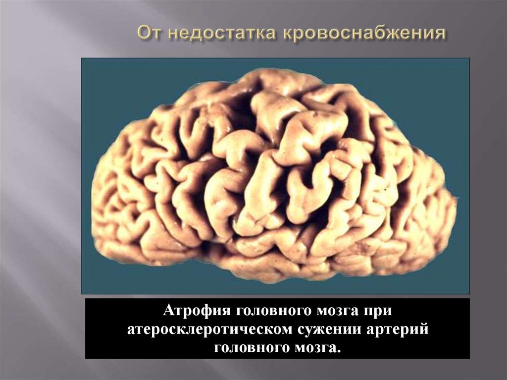 Атрофия мозга у взрослого