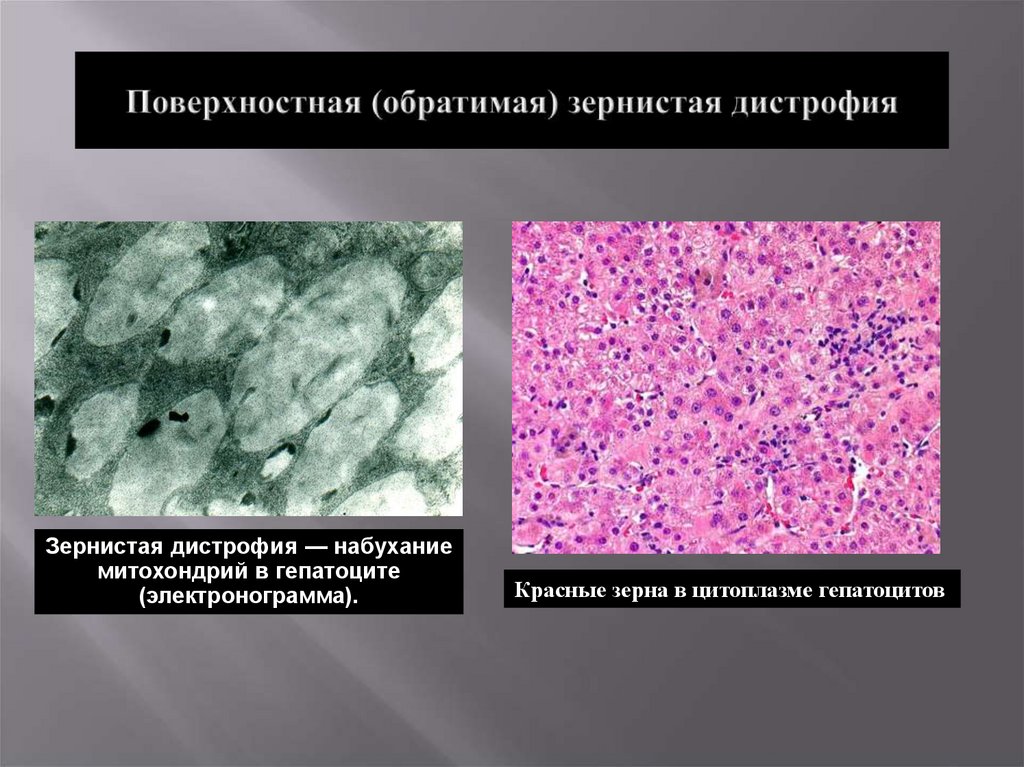 Процесс сопровождающийся накоплением в цитоплазме гепатоцитов. Электронограмма гидропическая дистрофия гепатоцитов. Зернистая дистрофия пример.