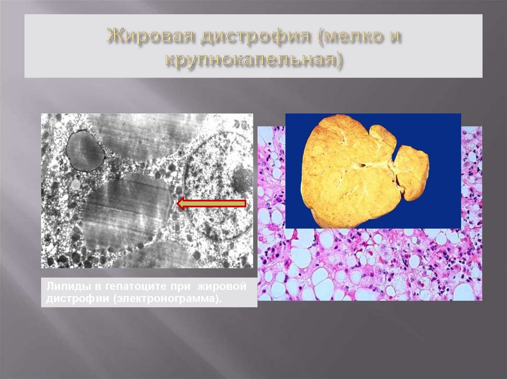 Жировая дистрофия презентация