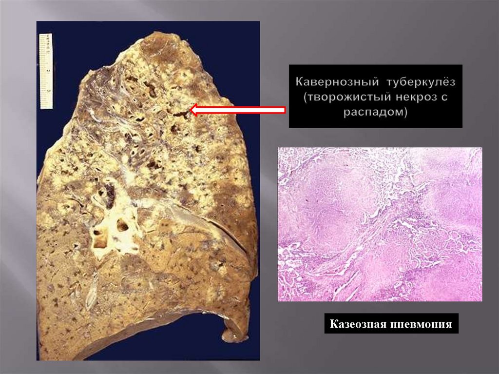 Кавернозный туберкулез