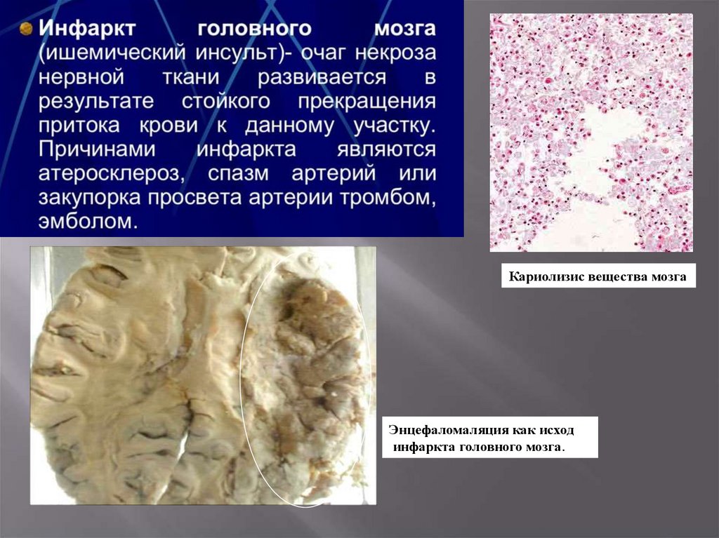 Инфаркт мозга это. Исходы инфаркта головного мозга. Исход ишемического инфаркта мозга. Ишемический инфаркт головного мозга неблагоприятные исходы. Исход при ишемическом инфаркте головного мозга.