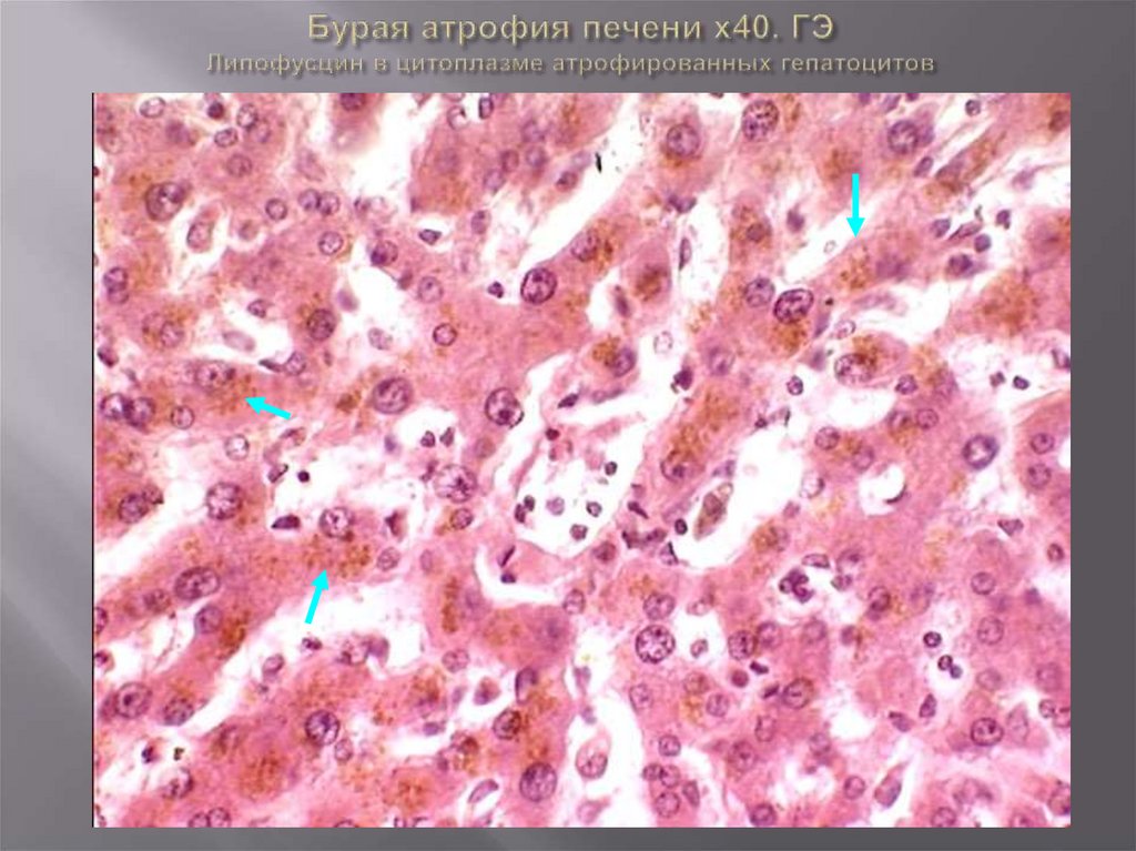 Процесс сопровождающийся накоплением в цитоплазме гепатоцитов. Бурая атрофия печени липофусциноз. Гидропическая дистрофия печени. Липофусциноз печени гистология. Липофусциноз патанатомия.