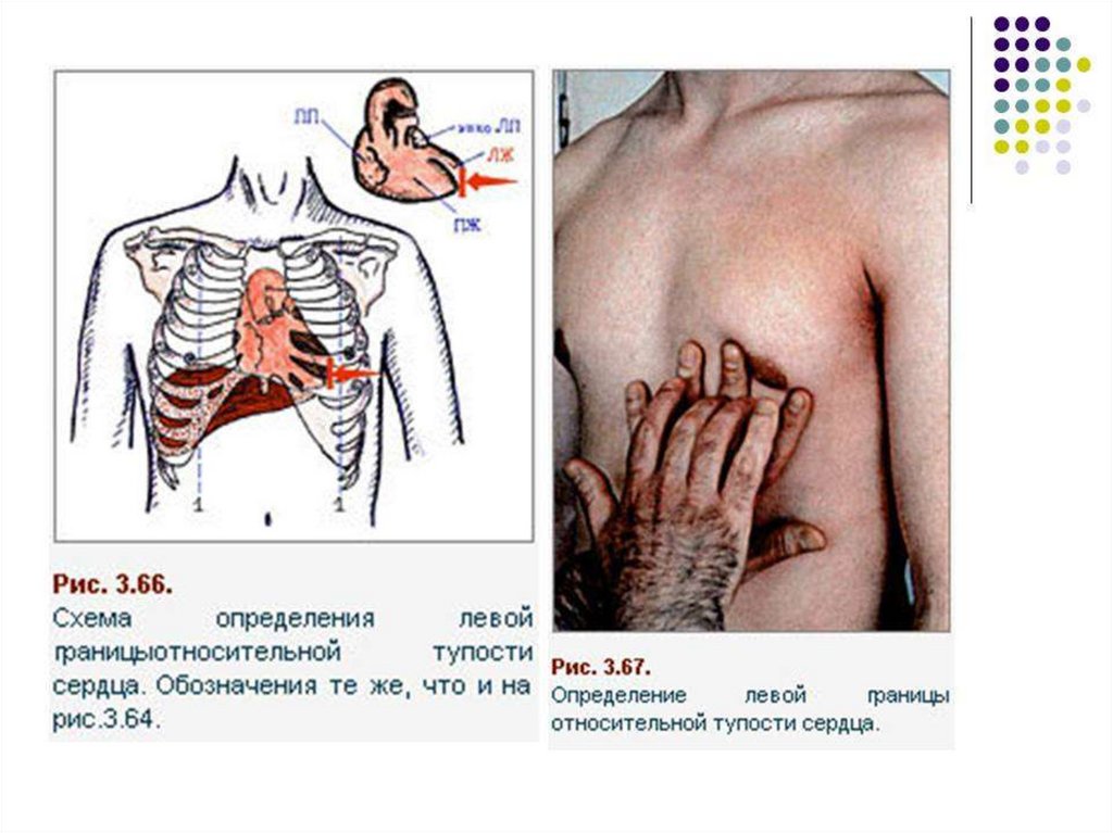 Сердечный относительно. Перкуссия и аускультация сердца. Перкуссия сердца. Перкуссия границ сердечной тупости. Методика перкуссии сердца.