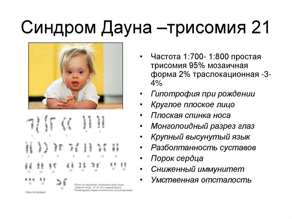 Фенотип ребенка с синдромом дауна. Синдром Дауна трисомия 21. Мозаичный синдром Дауна. Мозаичная форма синдрома Дауна. Мозаичнский синдром Дауна.