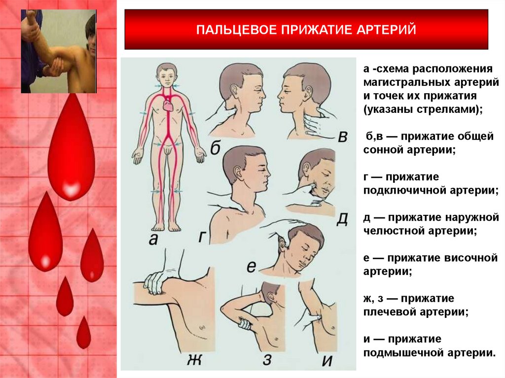 Как производится пальцевое прижатие подключичной артерии