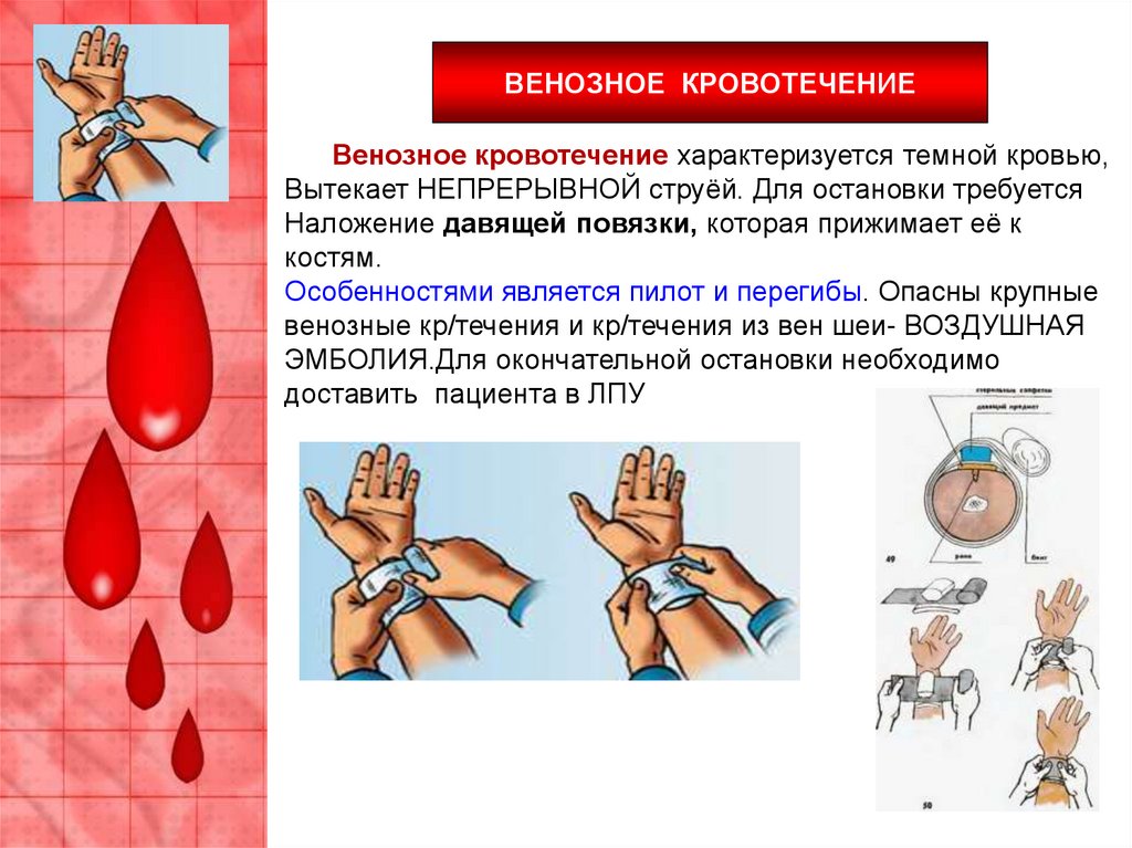 Какая кровь вытекает ручьем. Венозное кровотечение характеризуется. Чем характеризуется венозное кровотечение. Венозное кровотечение характеризуется тем что. Как характеризуется венозное кровотечение.