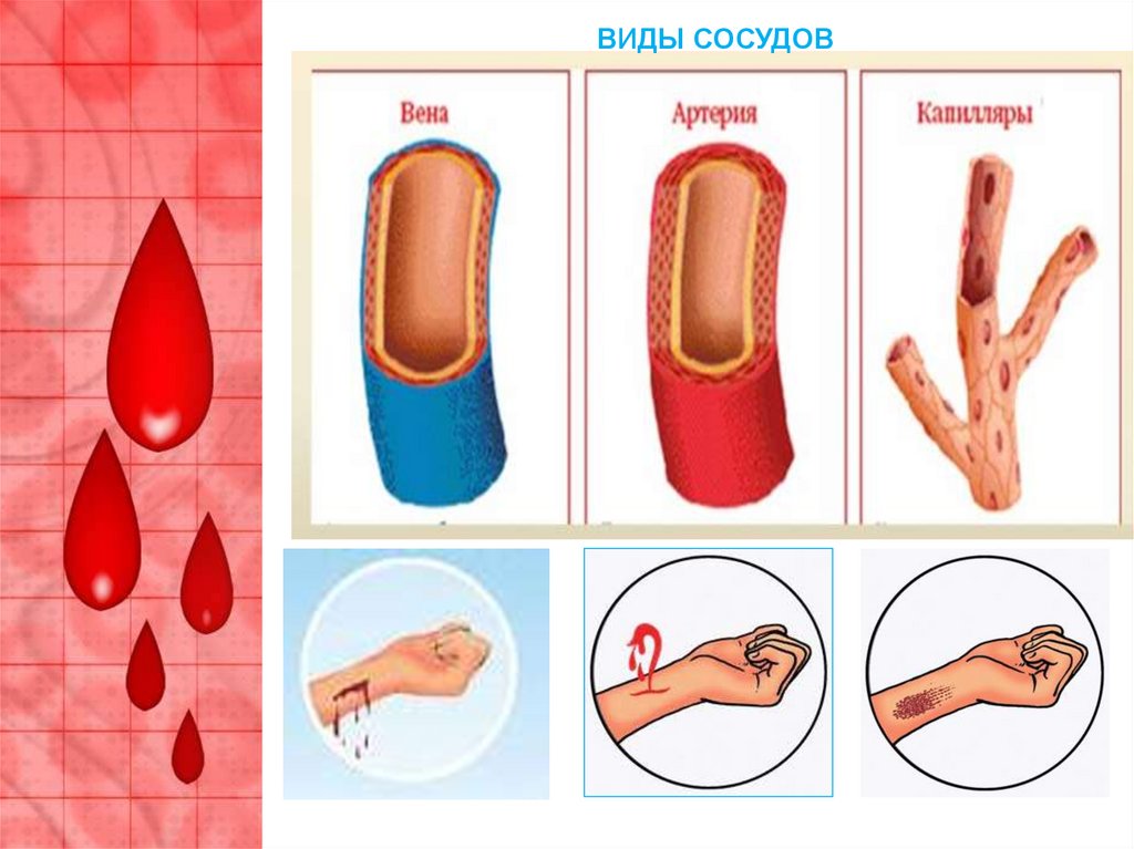 Виды сосудов. 3 Вида сосудов. Врастание сосудов в виде метелки. Муляжи кровоточащих РАН.