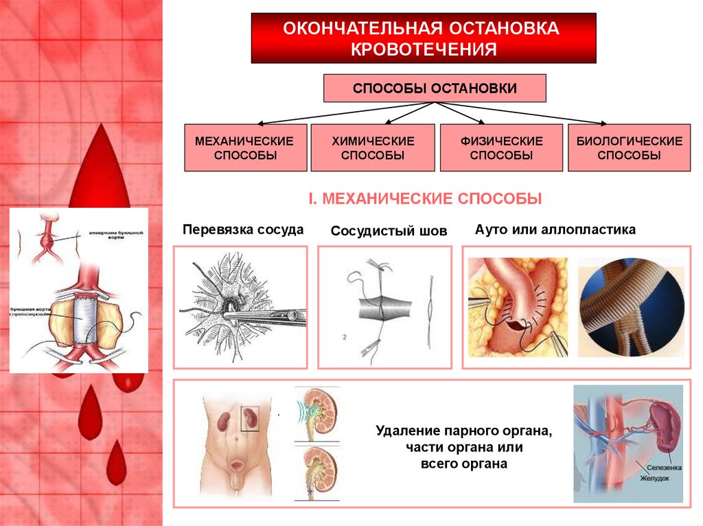 Окончательно е. Механический метод остановки кровотечения. Механические способы остановки кровотечения. Способы окончательной остановки кровотечения. Биологические методы окончательной остановки кровотечения.