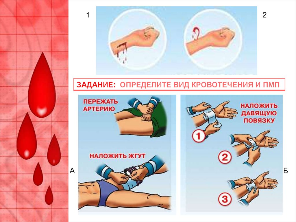 Осложнение ран кровотечение