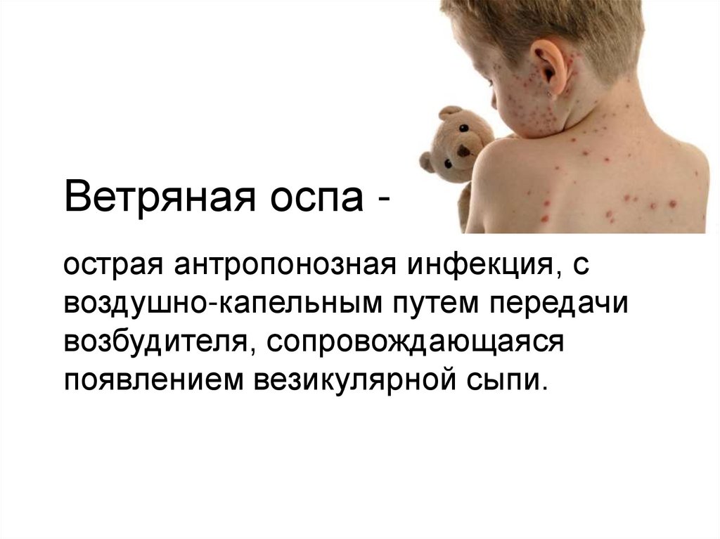 Ветряная оспа -