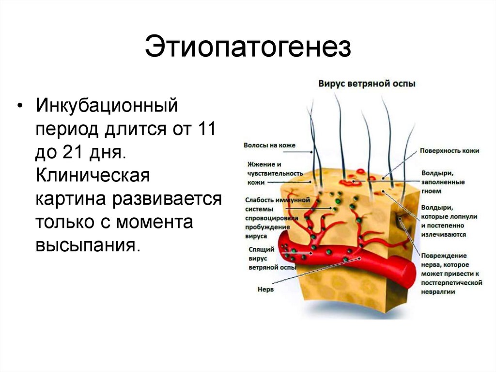 Антитела к вирусу ветряной оспы