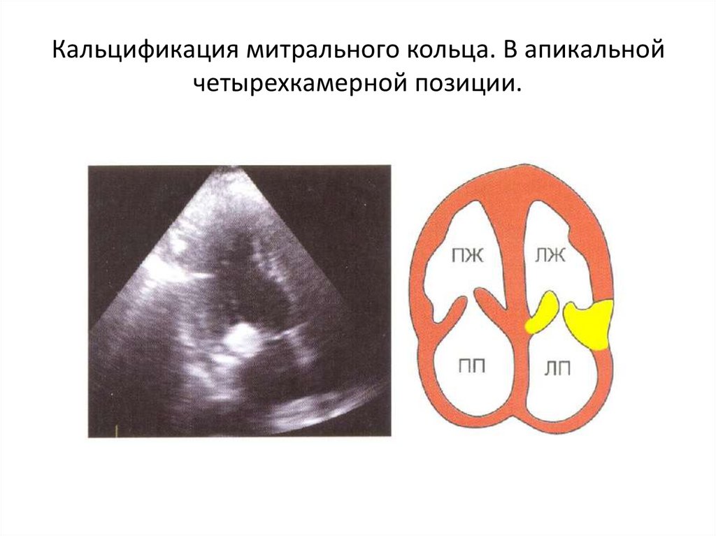 Кальциноз створок митрального клапана