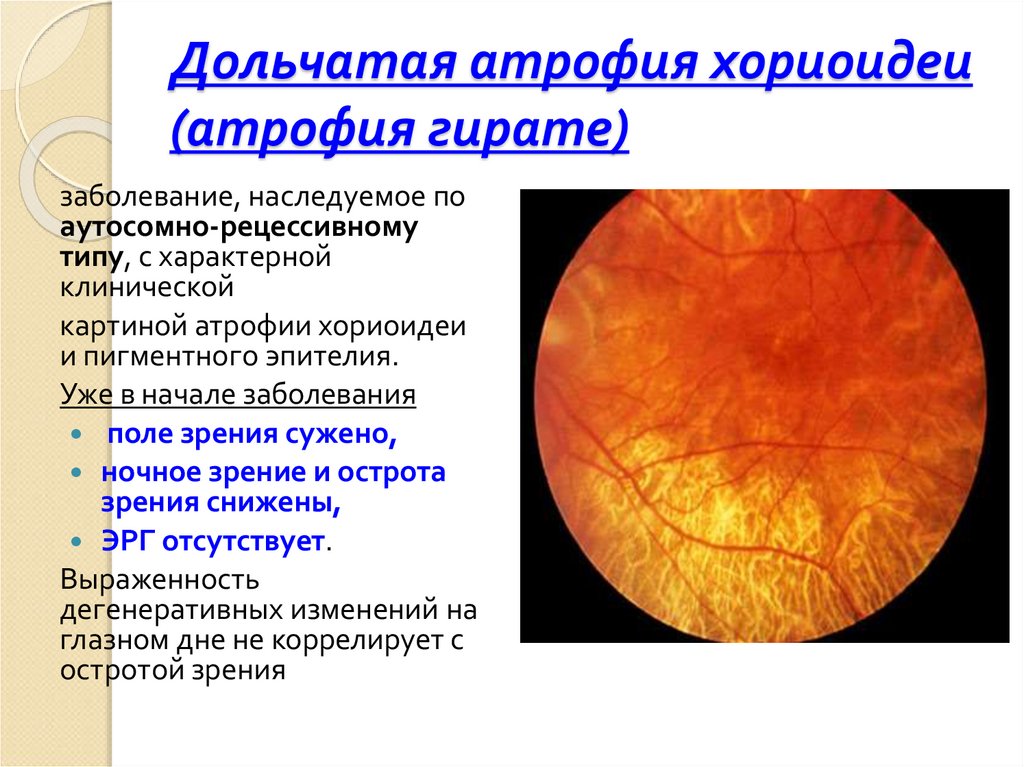 Новообразование хориоидеи. Дольчатая атрофия хориоидеи. Функции хориоидеи. Заболевания сосудистой оболочки глаза.
