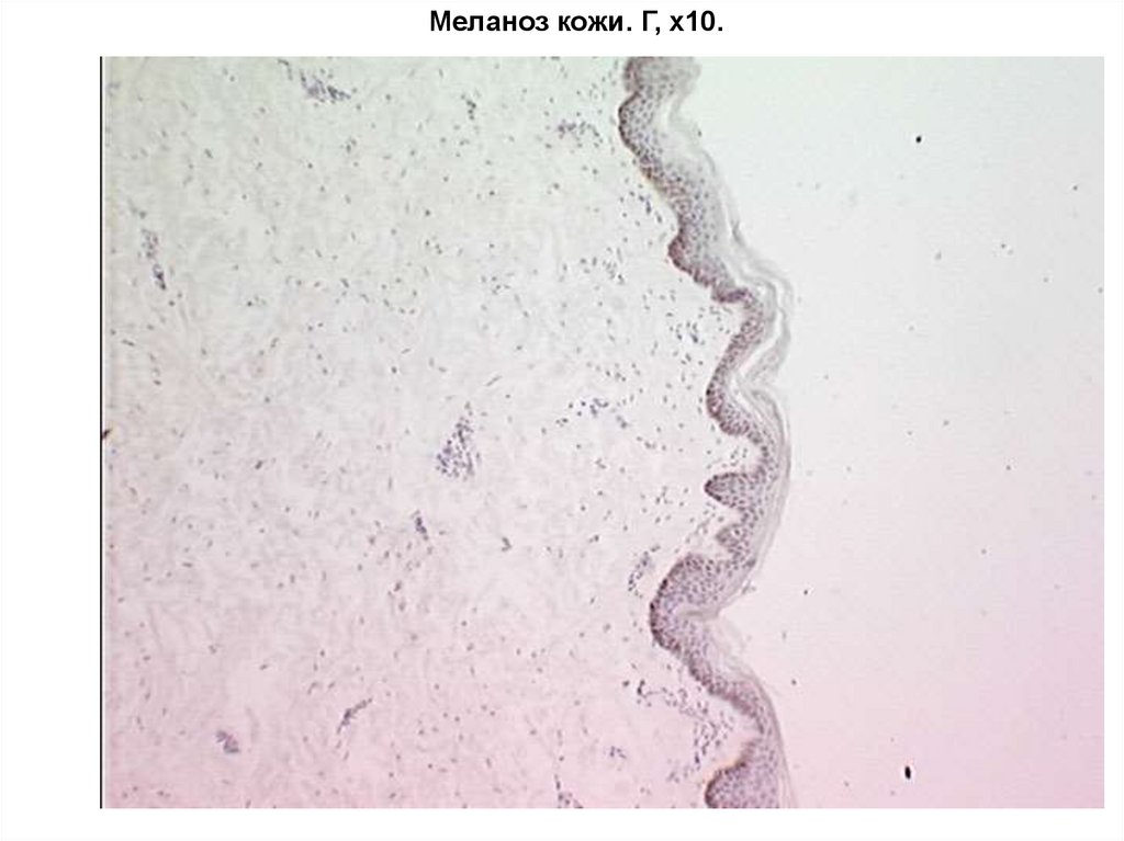 Меланоз кожи. Г, х10.