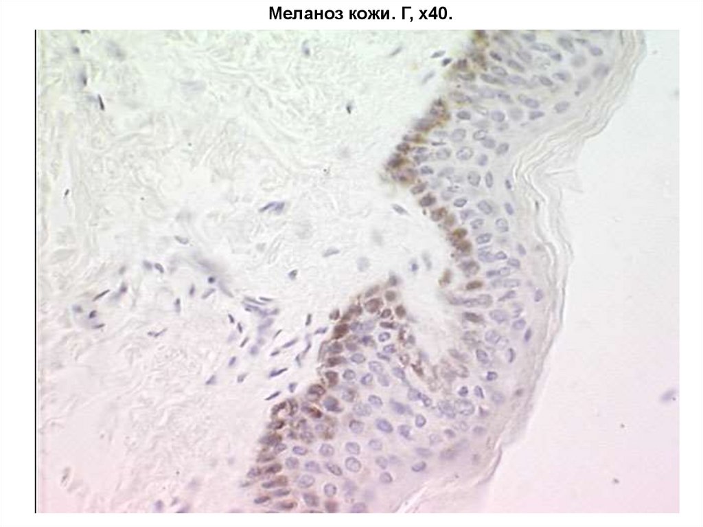 Меланоз кожи. Г, х40.