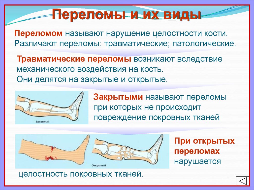 Симптомы перелома или трещины. Презентация на тему переломы костей. Травматические переломы.