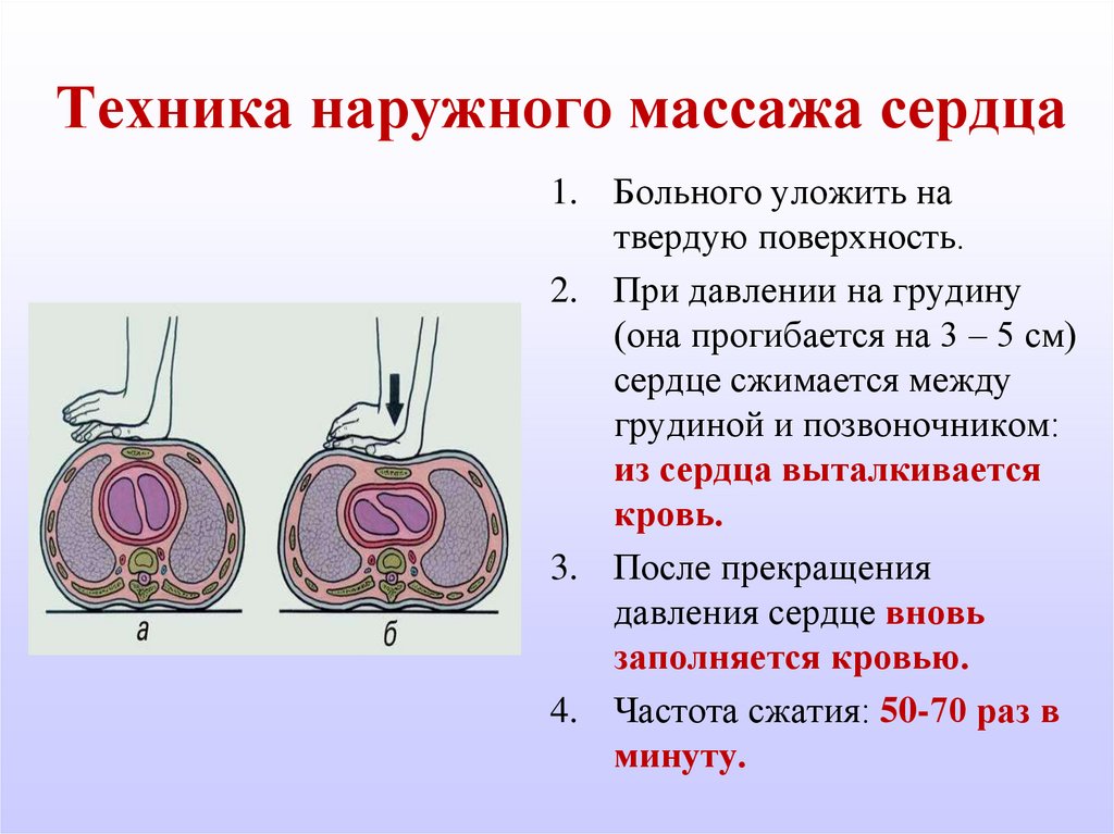 Частота непрямого. Наружный массаж сердца методика проведения. Опишите технику наружного массажа сердца. Методика наружного массажа сердца. Способы проведения наружного массажа сердца.