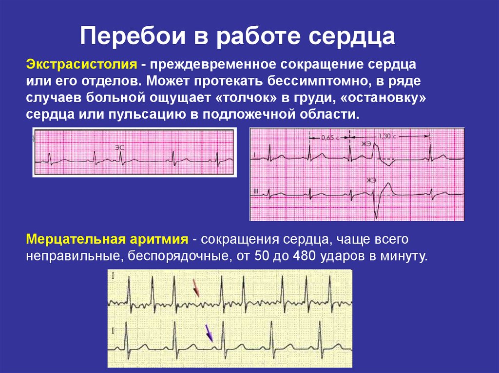 Сильное сердце что делать. Сердцебиение и перебои в работе сердца. Перебои в сердцебиении причины. Перебои в сердце на ЭКГ. Сердце работает с перебоями.