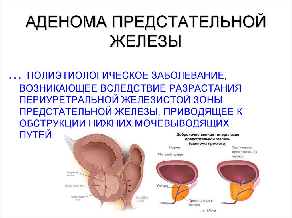 Что такое аденома предстательной железы. Аденома предстательной железы. Патология предстательной железы. Доброкачественная гиперплазия предстательной железы. Периуретральные железы предстательной железы.