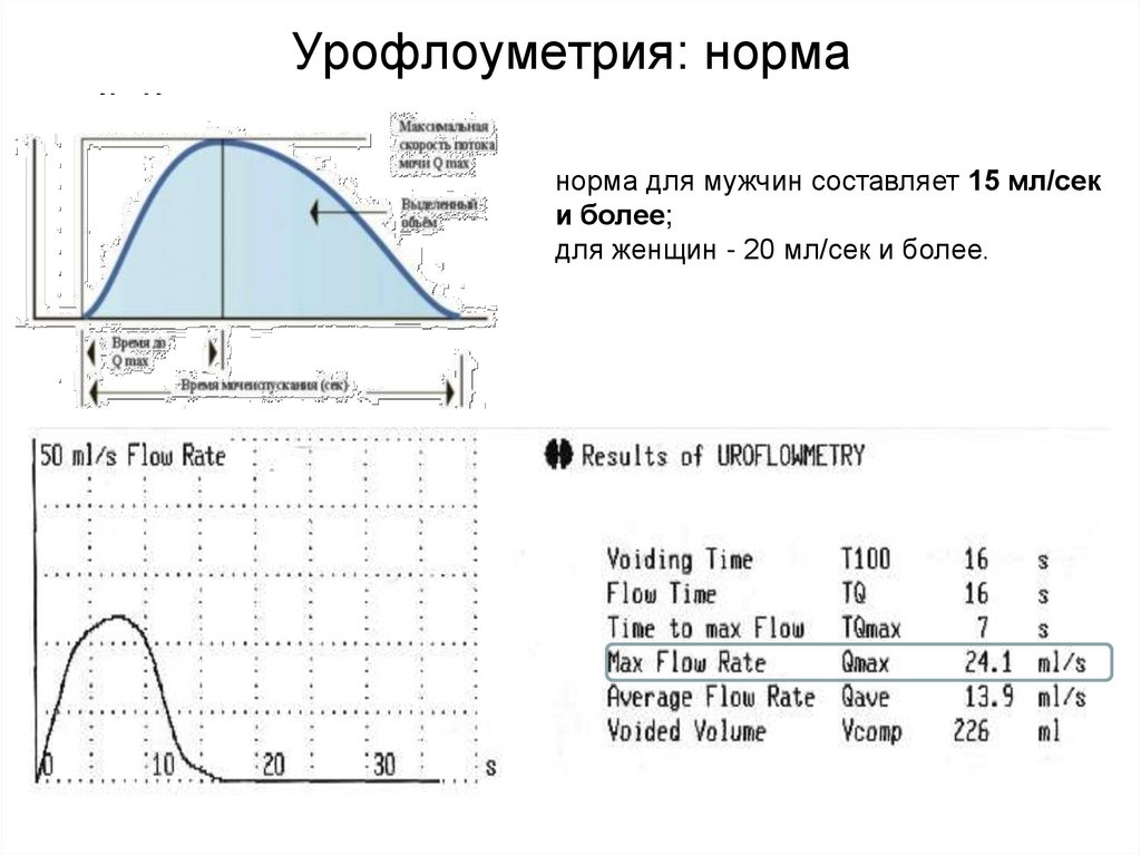 Урофлоуметрия как проводится. Урофлоуметрия типы мочеиспускания. Урофлоуметрия нормальная кривая. Кривая урофлоуметрии в норме. Урофлоуметрия расшифровка показателей у мужчин норма.