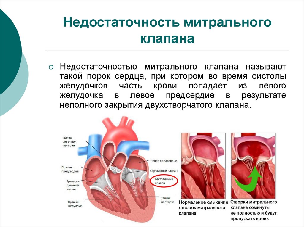 Сердечная недостаточность митрального клапана. Недостаточность митрального клапана 1. Строение митрального клапана сердца. Недостаточность митрального клапана 1 степени. При недостаточности митрального клапана.