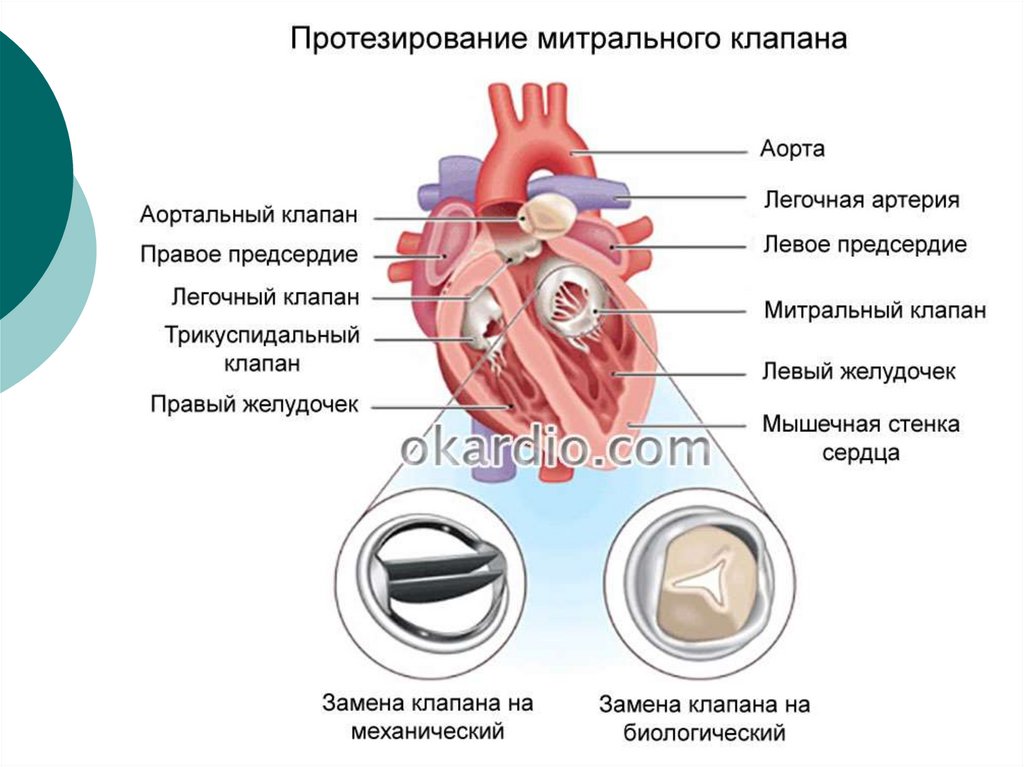 Как клапан делает операция. Клапаны сердца аортальный клапан. Митральный клапан и аортальный клапан. Протезирование митрального клапана. Сердце операция митральный клапан.