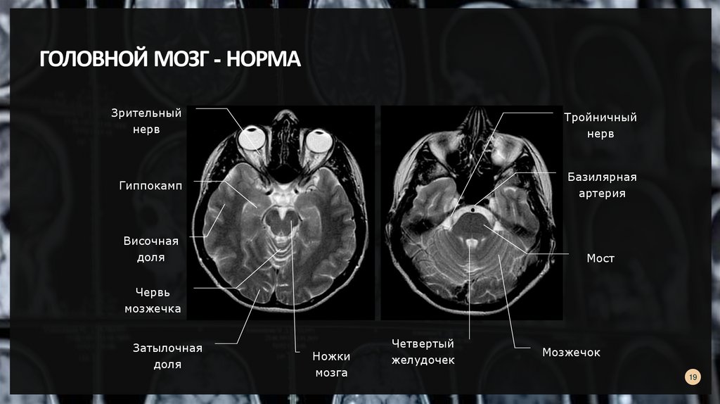 Норма мозга