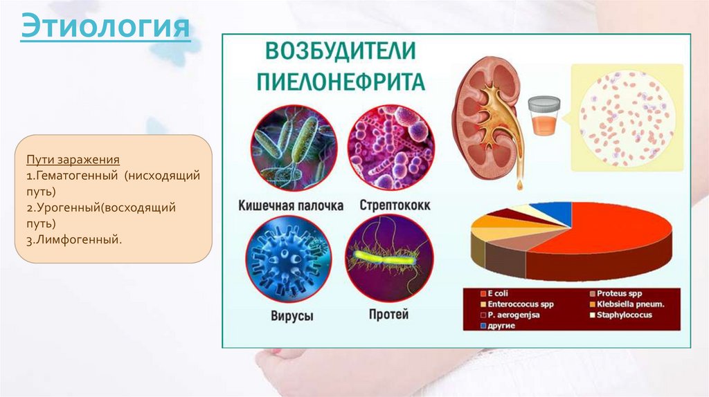 Гестационный пиелонефрит - презентация онлайн