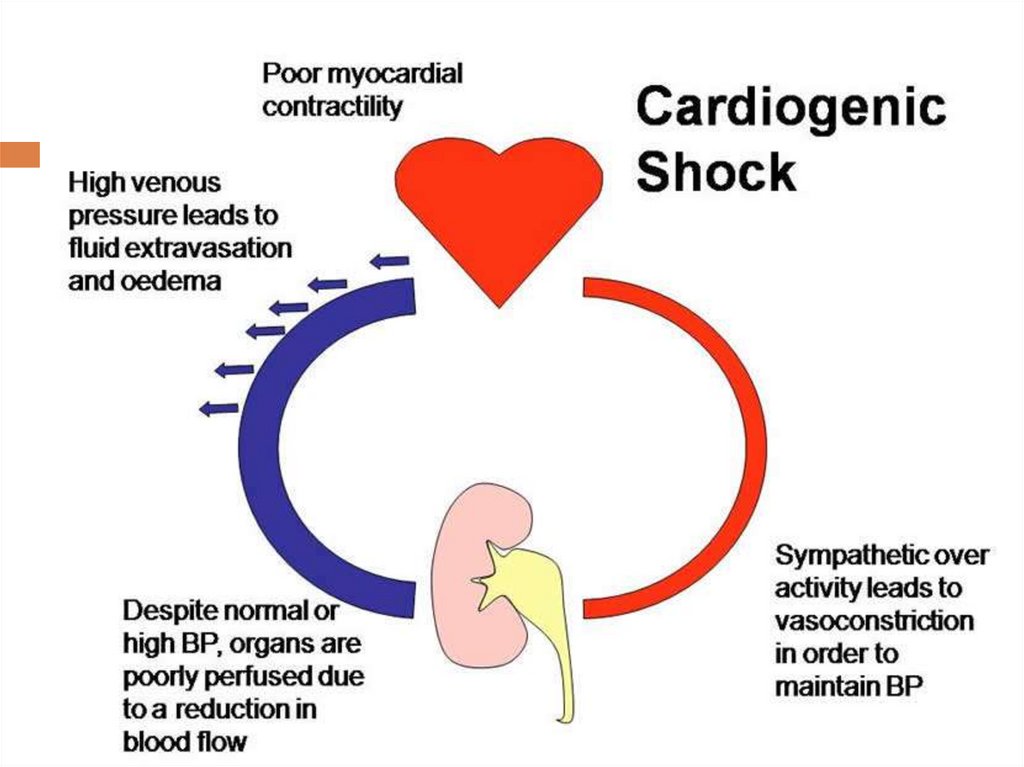 От мозга кровь оттекает. Cardiogenic Shock. Normal Cardiac output. Интенсивная терапия и реанимация при кардиогенном шоке.