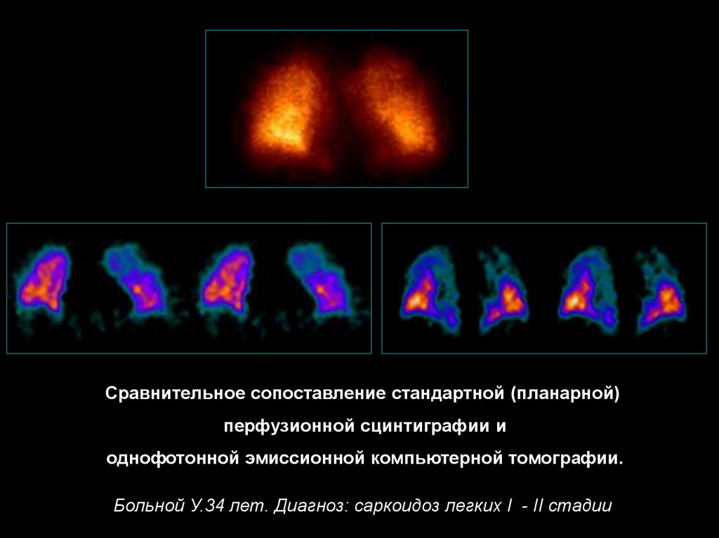 Сцинтиграфия желез