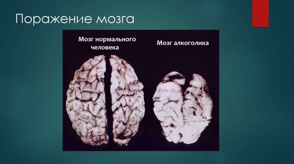 Поражение мозга