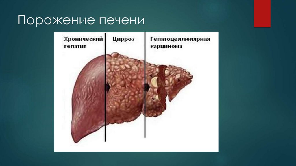 Поражение печени