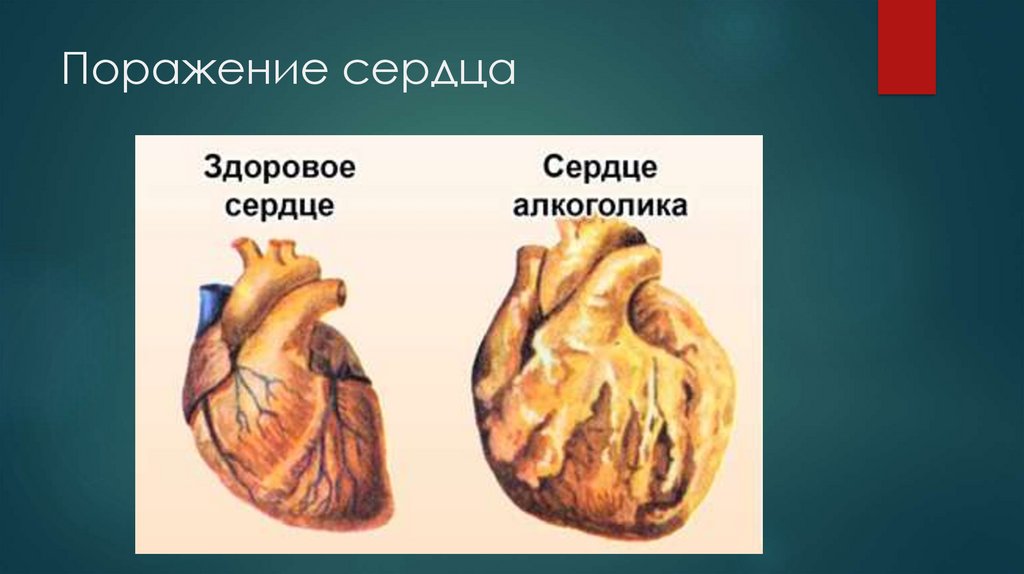 Поражение сердца