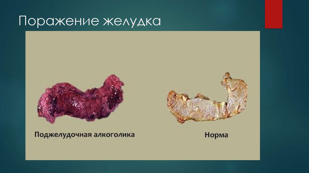 Поражение желудка