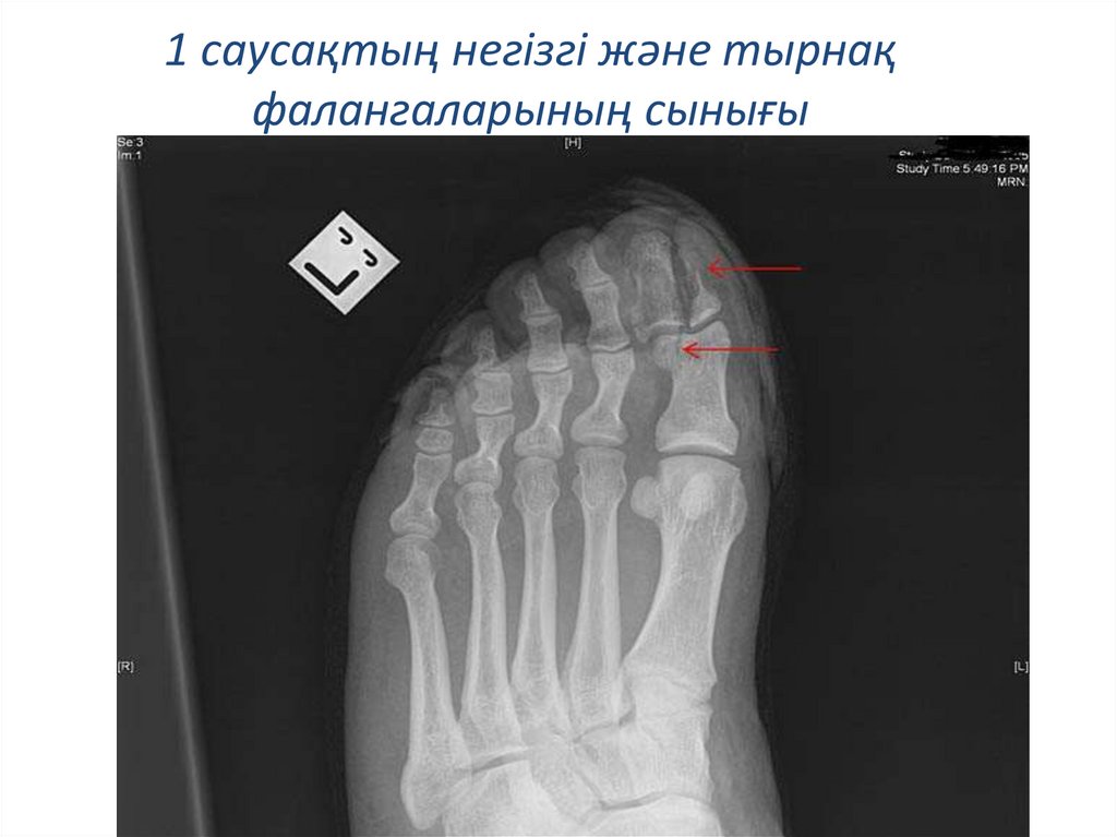 Ногтевой фаланги пальца ноги. Перелом основной фаланги 1 пальца стопы рентген. Перелом основной фаланги рентген. Закрытый краевой перелом ногтевой фаланги 1 пальца правой стопы. Краевой перелом основной фаланги 1 пальца ноги.