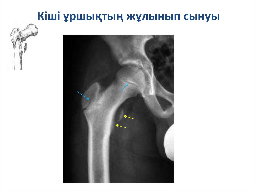 Вертел бедренной кости фото