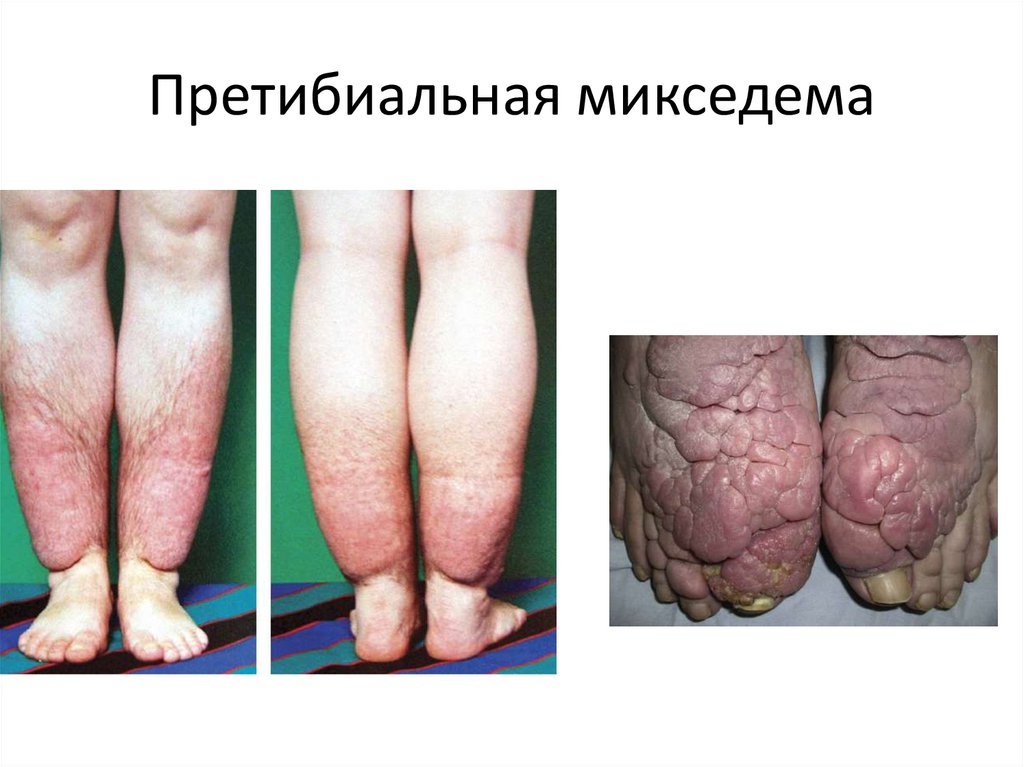 Претибиальная микседема