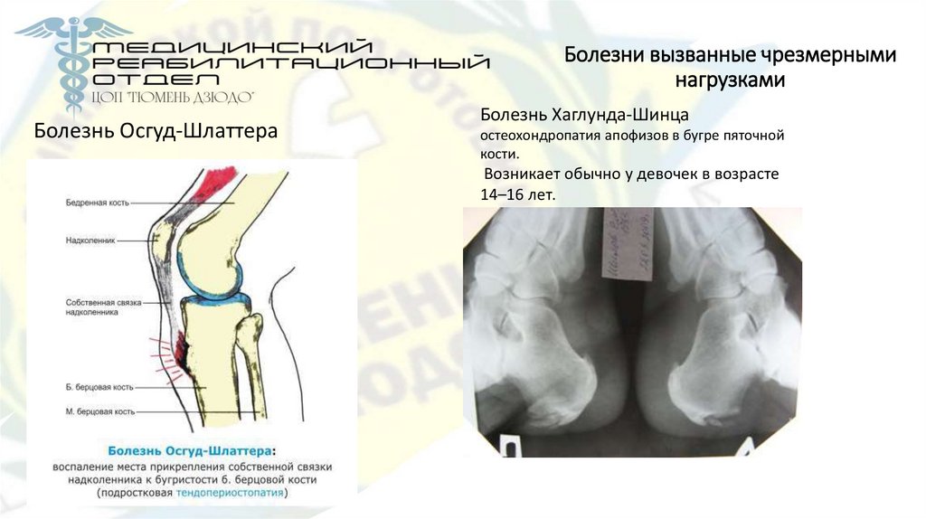 Болезни вызванные чрезмерными нагрузками