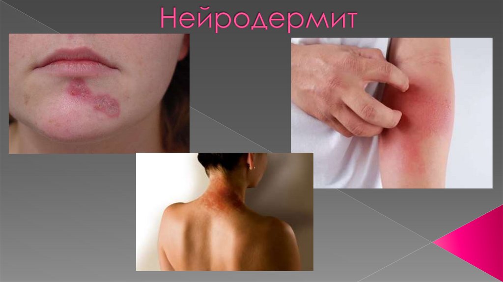 Нейродермит