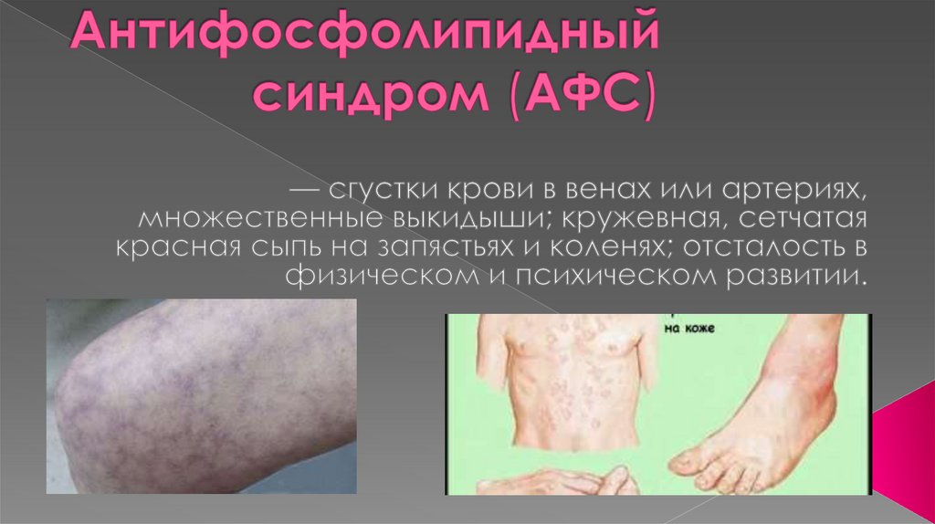 Антифосфолипидный синдром (АФС)